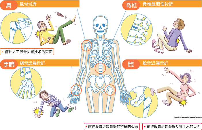 关于老年人的骨折