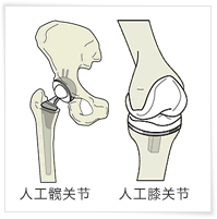 什么是人工关节?