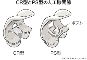 CR型とPS型の人工膝関節