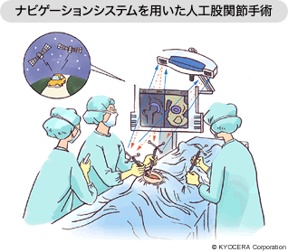 ナビゲーションシステムを用いた人工股関節手術