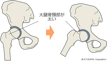 FAIの原因 大腿骨頸部が太い