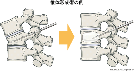 椎体形成術の例