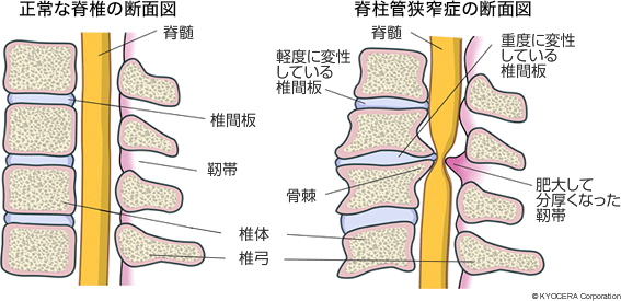 正常な脊椎の断面図 脊柱管狭窄症の断面図