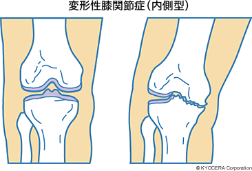 変形性膝関節症（内側型）