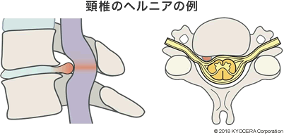 頸椎のヘルニアの例