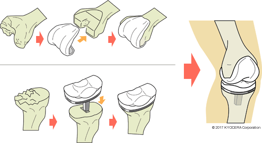人工膝関節手術の例