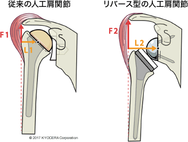 リバースタイプの人工肩関節が小さい筋力で働く仕組み