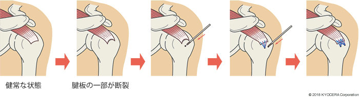 腱板修復術の例