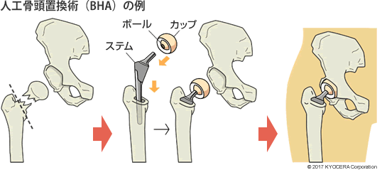 人工骨頭置換術（BHA）の例