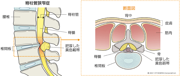 脊柱管狭窄症 断面図