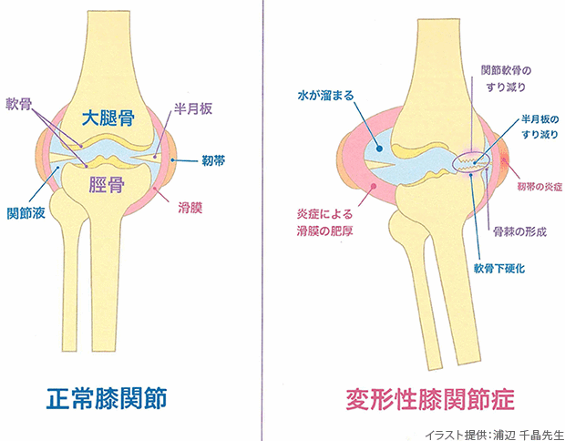 正常膝関節 変形性膝関節症