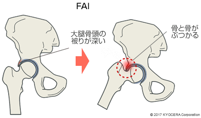 大腿骨寛骨臼インピンジメント（FAI：エフエーアイ）