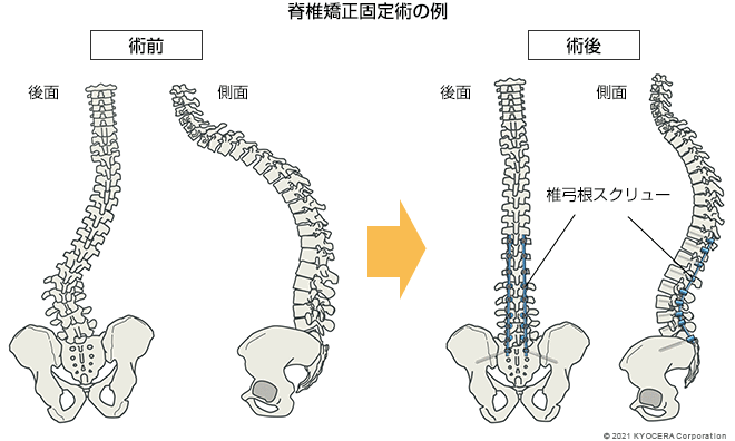 脊椎矯正固定術の例