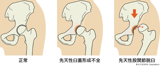 正常 先天性臼蓋形成不全 先天性股関節脱臼