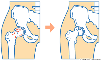 大腿骨頭壊死症 イラスト