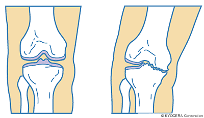 変形性膝関節症 イラスト