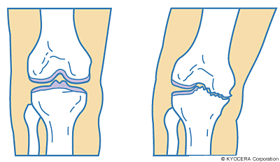 変形性膝関節症 関節とは 人工関節と関節痛の情報サイト 関節が痛い Com