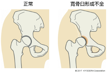 正常 寛骨臼形成不全