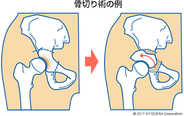 骨切り術の例