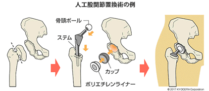 人工股関節置換術の例