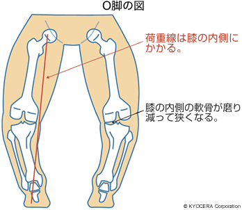 O脚の図