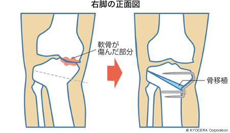 右脚の正面図