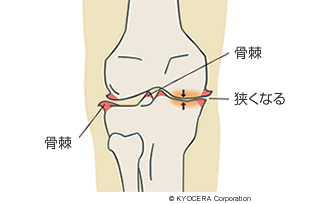膝関節の骨棘