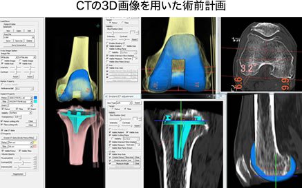CTの3D画像を用いた術前計画
