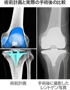 術前計画と実際の手術後の比較