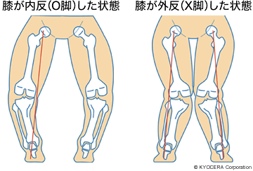 膝が内反（O脚）した状態、膝が外反（X脚）した状態