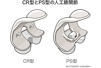 CR型とPS型の人工膝関節