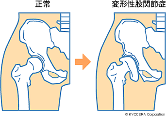 正常、変形性股関節症