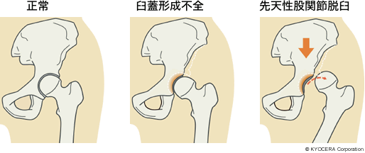 正常、臼蓋形成不全、先天性股関節脱臼