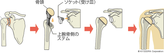 従来の人工肩関節