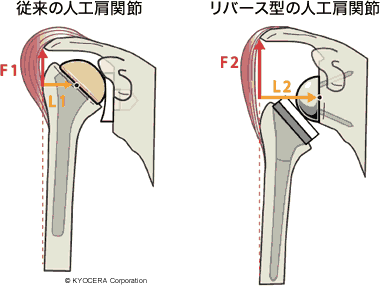 従来の人工肩関節、リバース型の人工肩関節