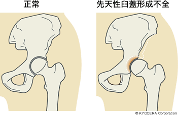 正常、先天性臼蓋形成不全