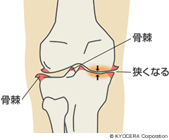 骨棘