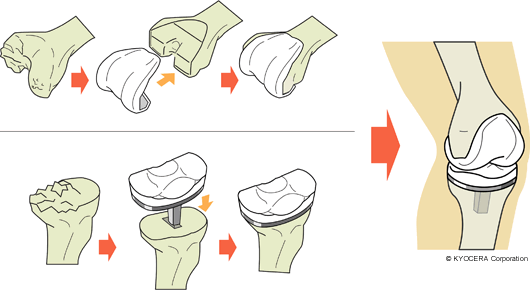 人工膝関節全置換術