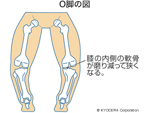 O脚の図