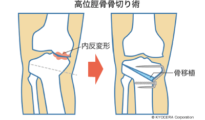 高位脛骨骨切り術