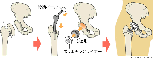 人工股関節