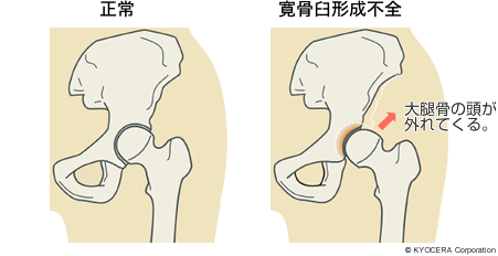 正常、寛骨臼形成不全