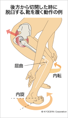 後方から切開した時に脱臼する、靴を履く動作の例