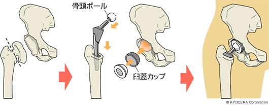 人工股関節全置換術