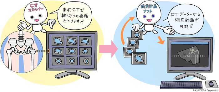 コンピュータを利用した術前計画