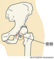 骨棘