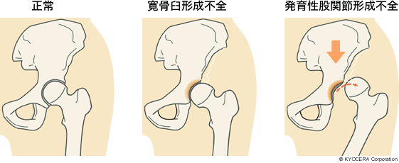 正常、寛骨臼形成不全、発育性股関節形成不全