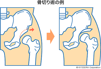 骨切り術の例