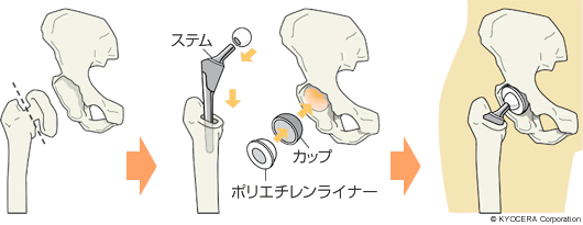 人工股関節全置換術