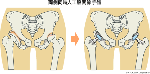 両側同時人工股関節手術